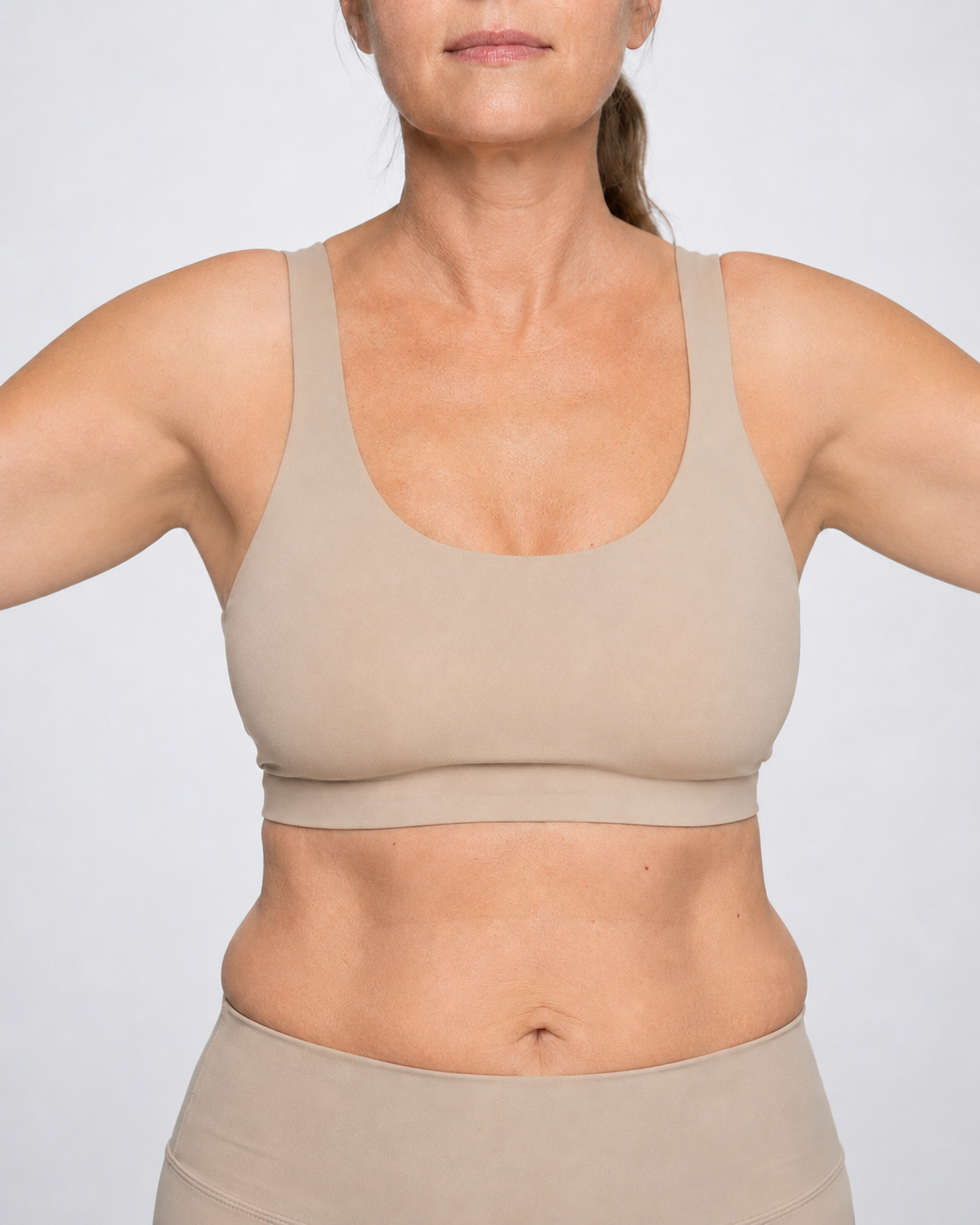 After brachioplasty arm contouring result